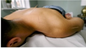 About Acupuncture